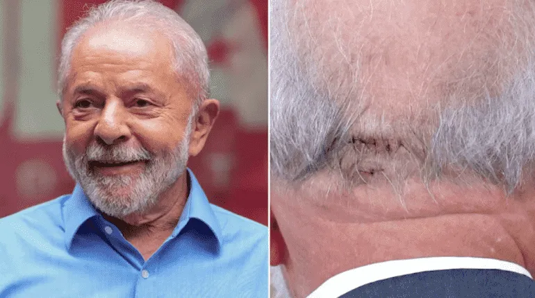 Lula da Silva y su herida en la cabeza.